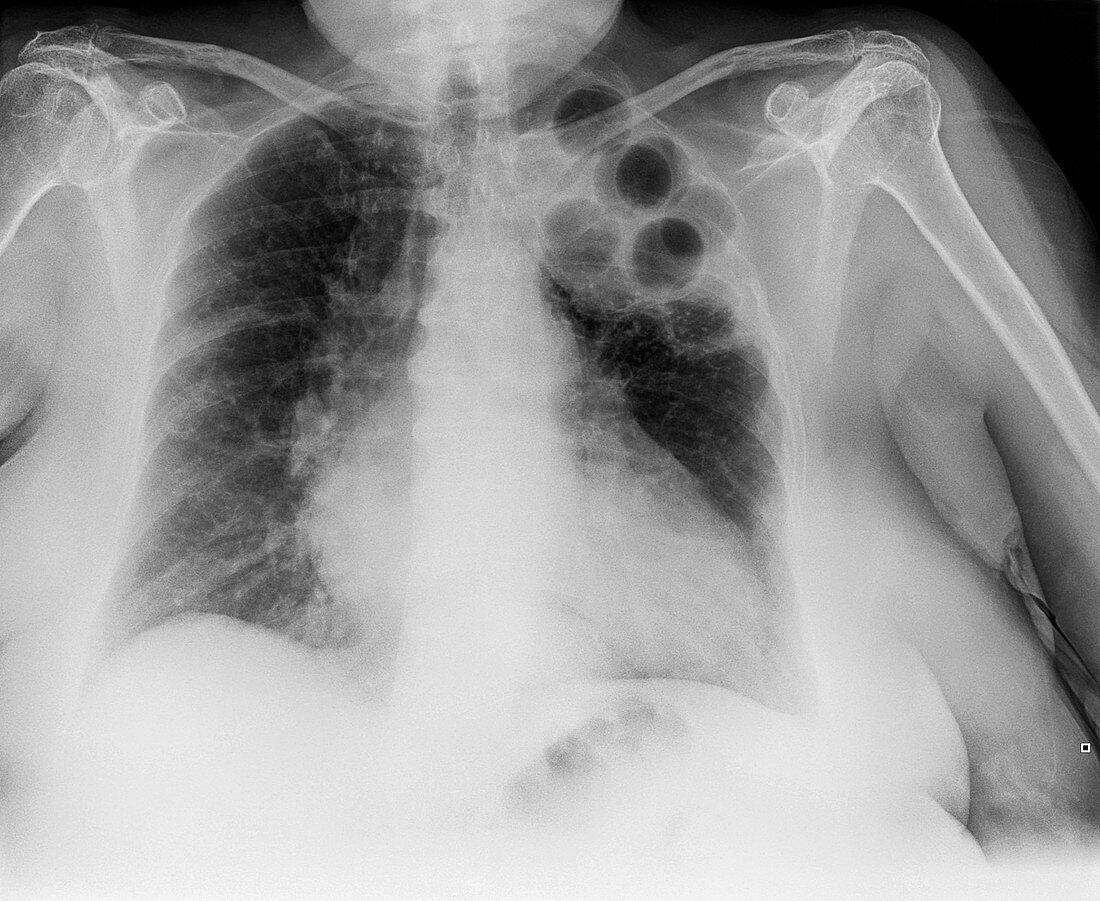 Plombage tuberculosis treatment, X-ray