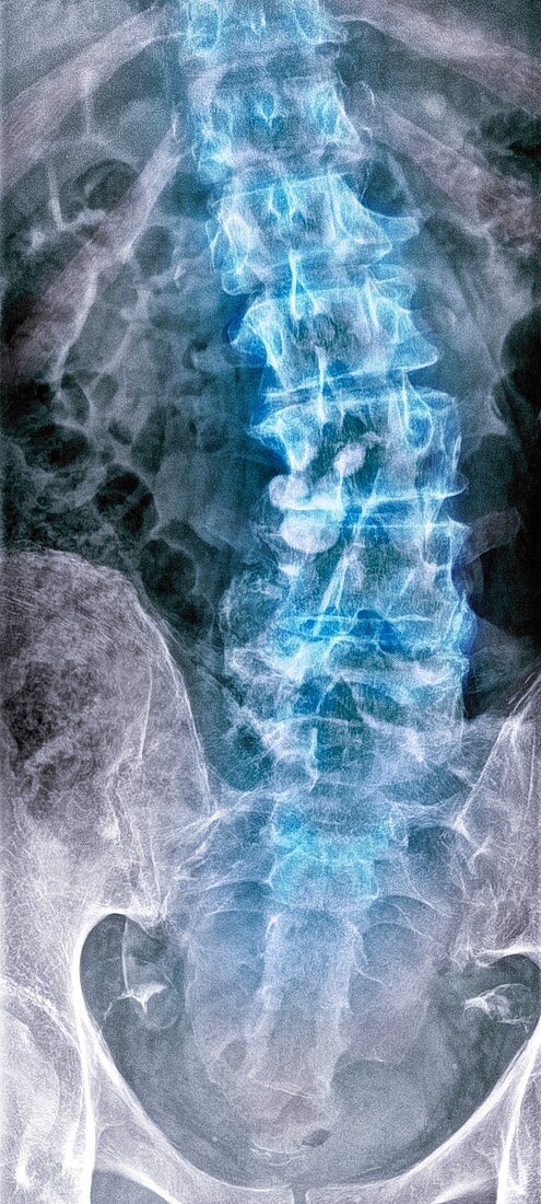 Kyphoscoliosis, X-ray
