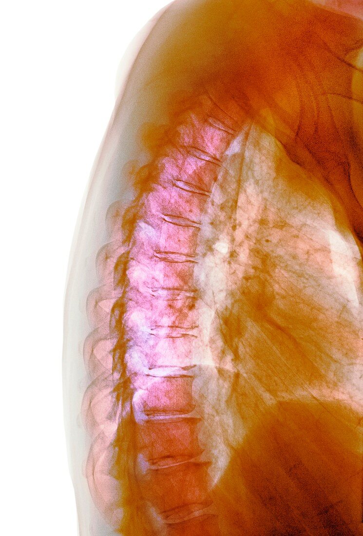 Osteoarthritis of the spine, X-ray