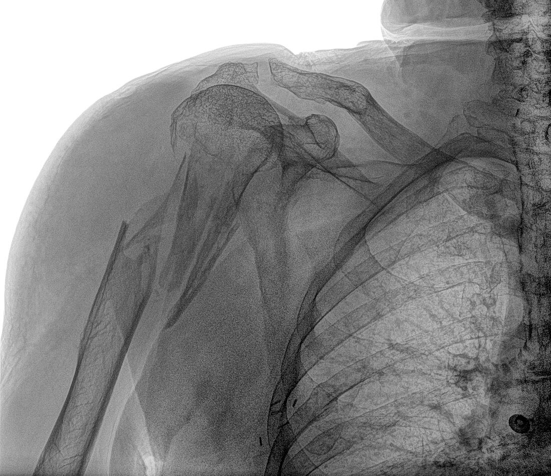 Broken upper arm bone, X-ray