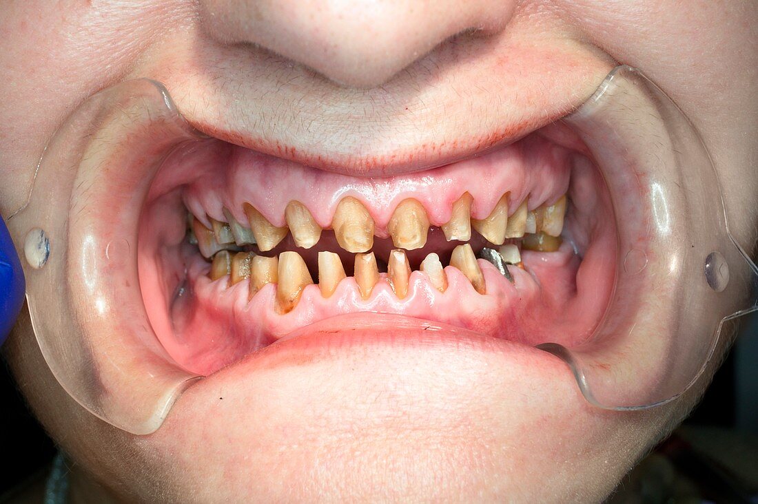 Teeth during dental crown surgery