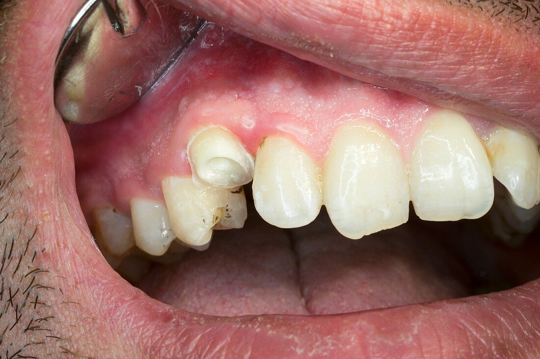 Dental malocclusion correction