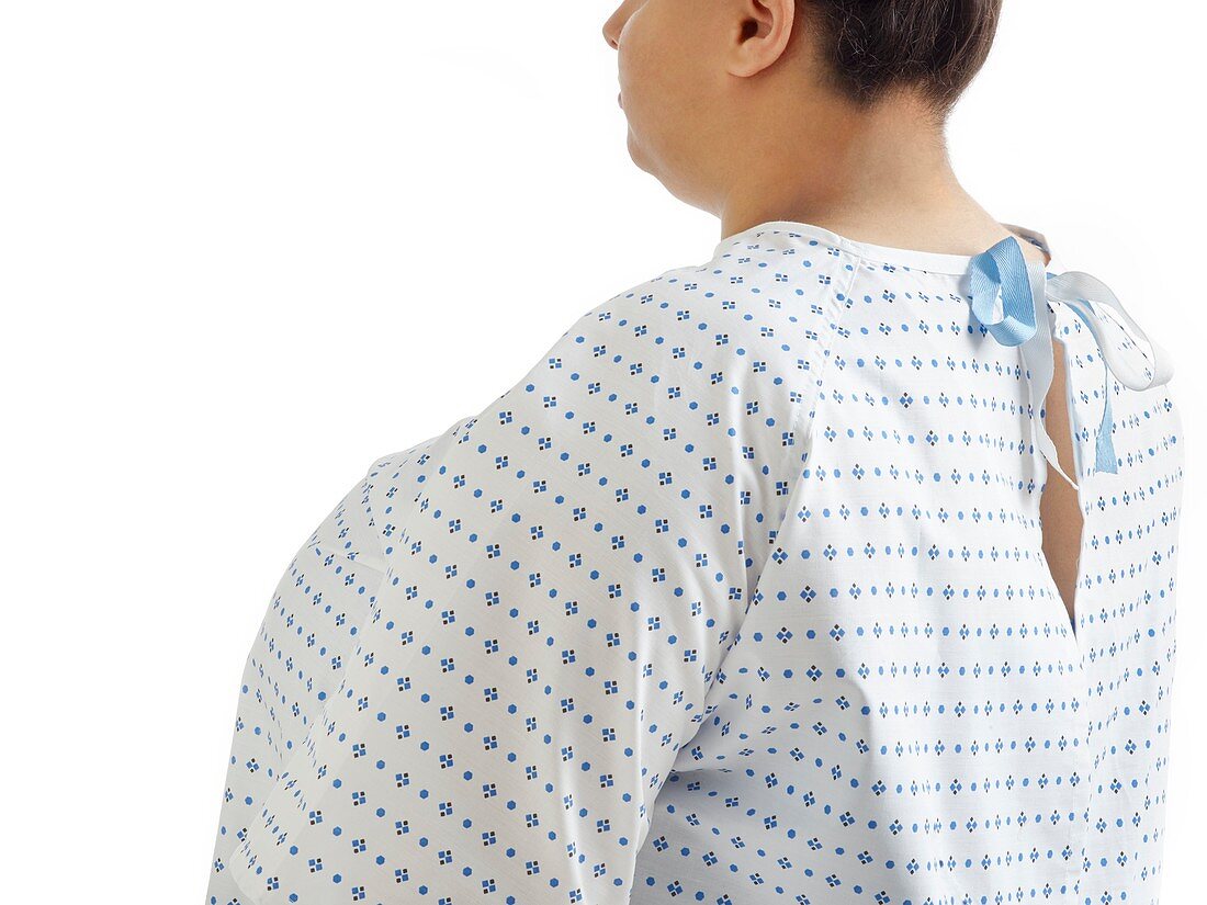 Overweight woman in hospital gown, rear view