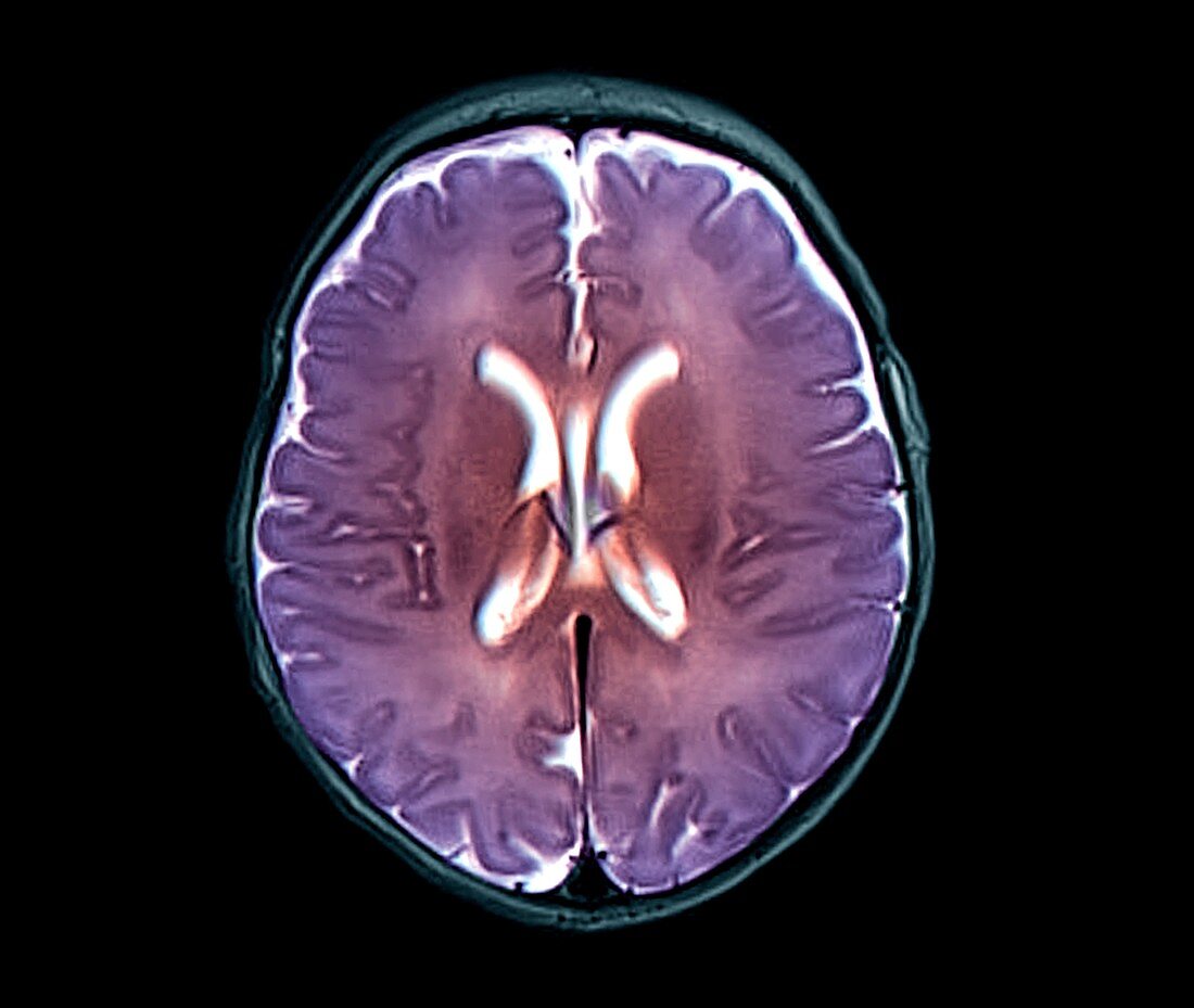 Brain ventricle anomaly, MRI scan
