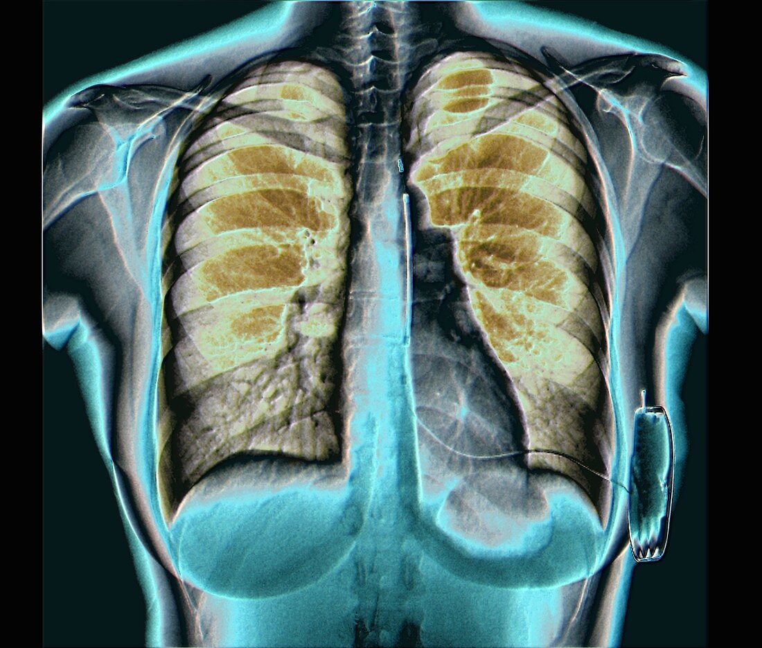 Cardiac defibrillator, chest X-ray