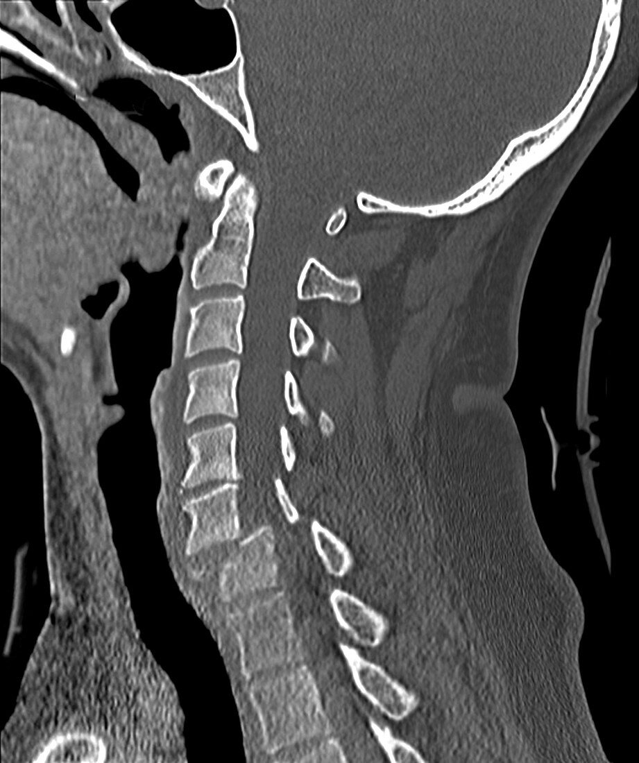 Whiplash neck injury, CT scan