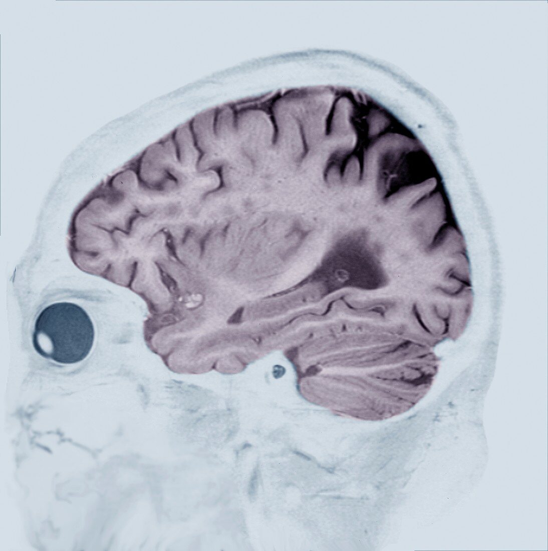 Alzheimer's disease, MRI brain scan