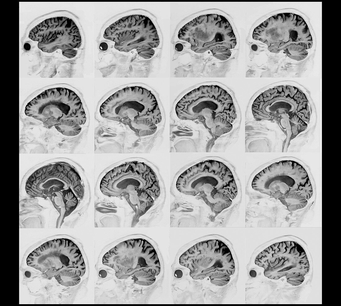 Alzheimer's disease, MRI brain scans