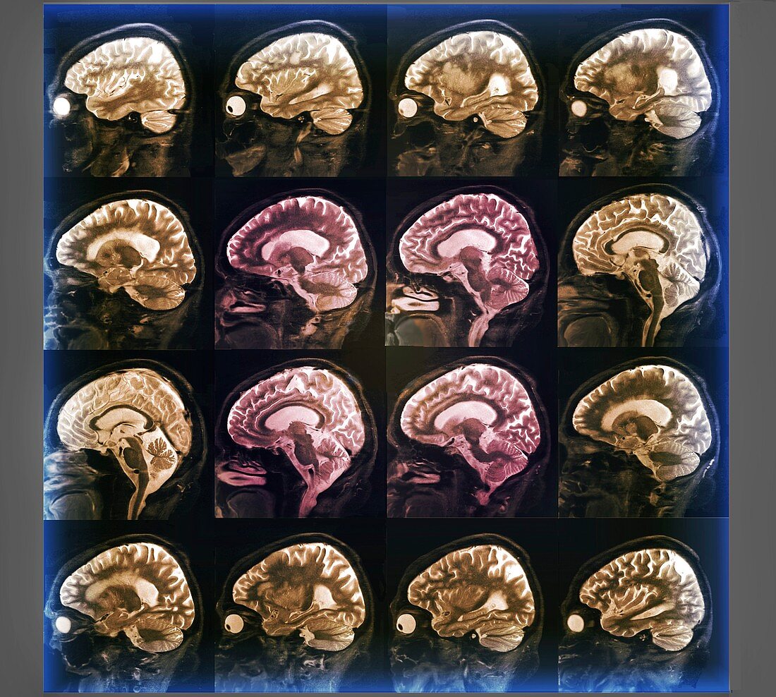 Alzheimer's disease, MRI brain scans