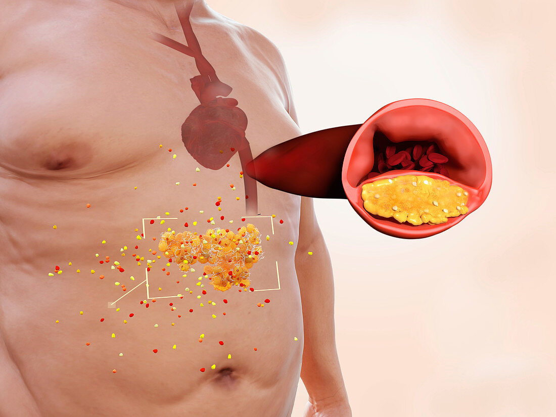 Visceral fat and heart disease, illustration