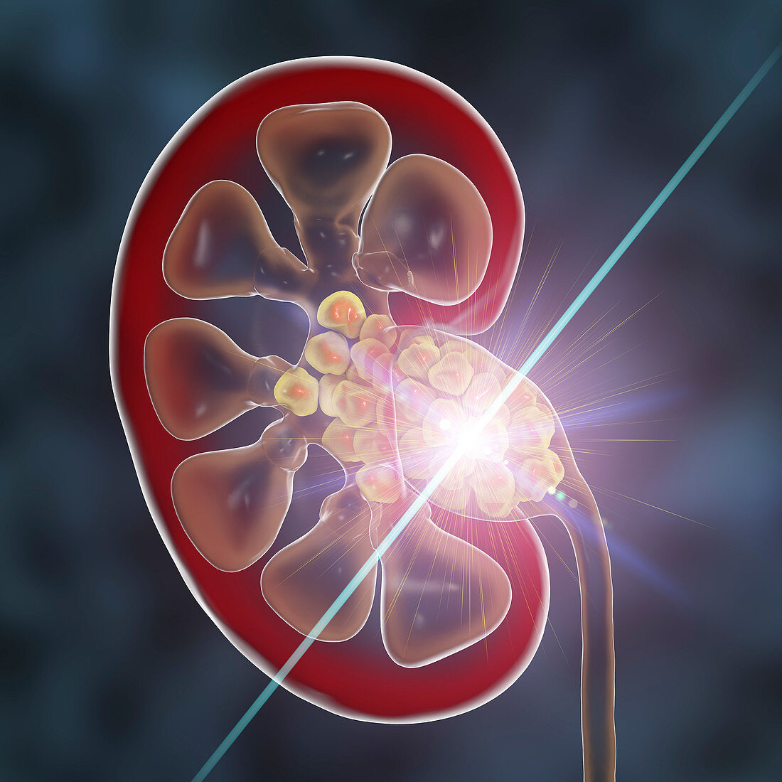 Kidney stone treatment, conceptual illustration