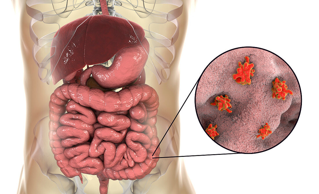Parasitic amoeba in large intestine, illustration