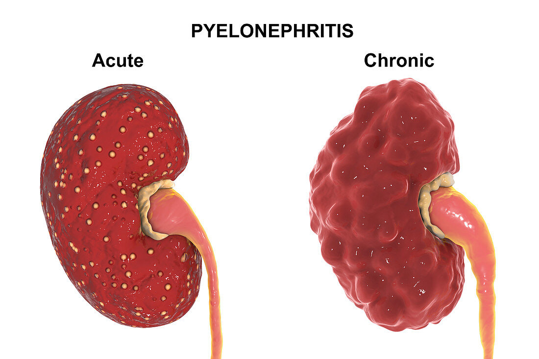 Comparison of gross anatomy of acute and chronic pyelonephri