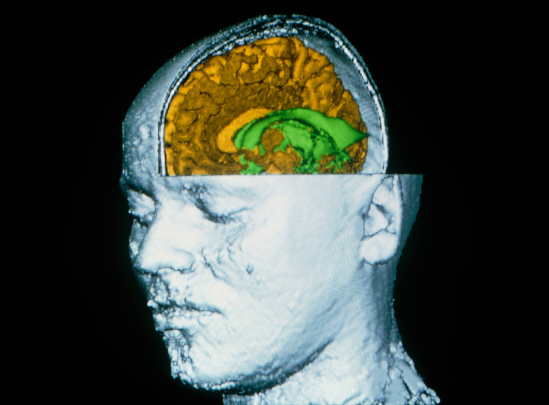 Coloured 3-D MRI scan of brain in cut-away head