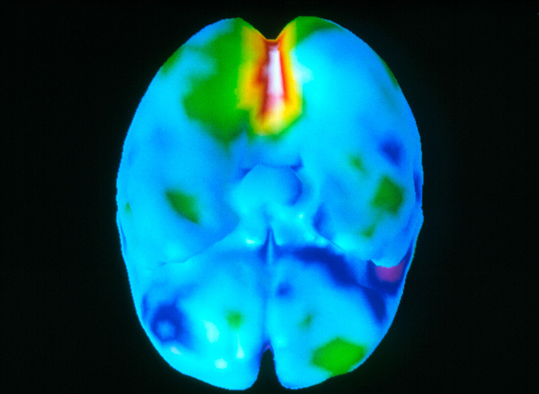 Coloured 3-D PET brain scan during visual activity