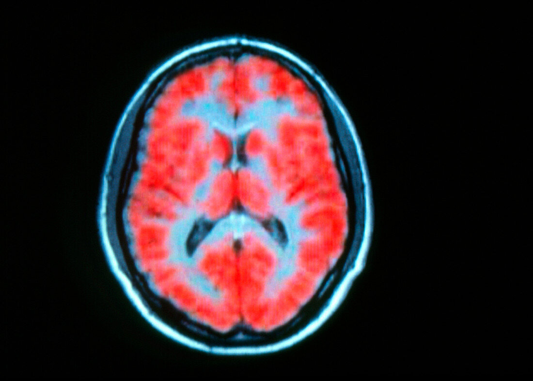 PET scan of brain activity on MRI