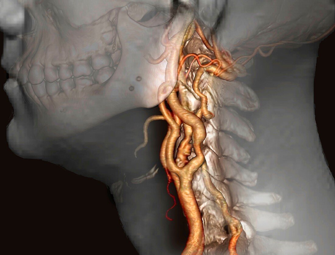 Atherosclerosis in neck arteries, 3D CT scan