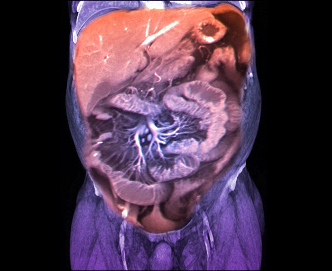 Crohn's disease research, MRI scan