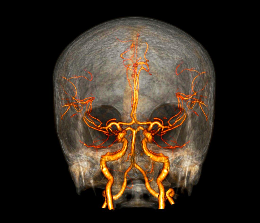 Brain and neck arteries, 3D CT angiogram