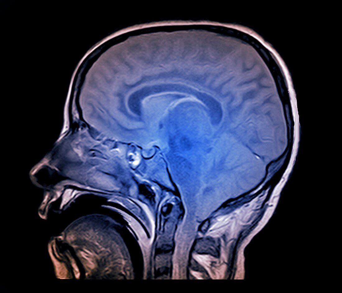 Brain death test, MRI scan