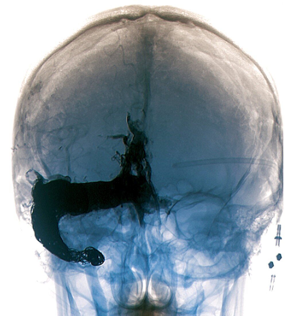 Cerebral arteriovenous malformation treatment, X-ray
