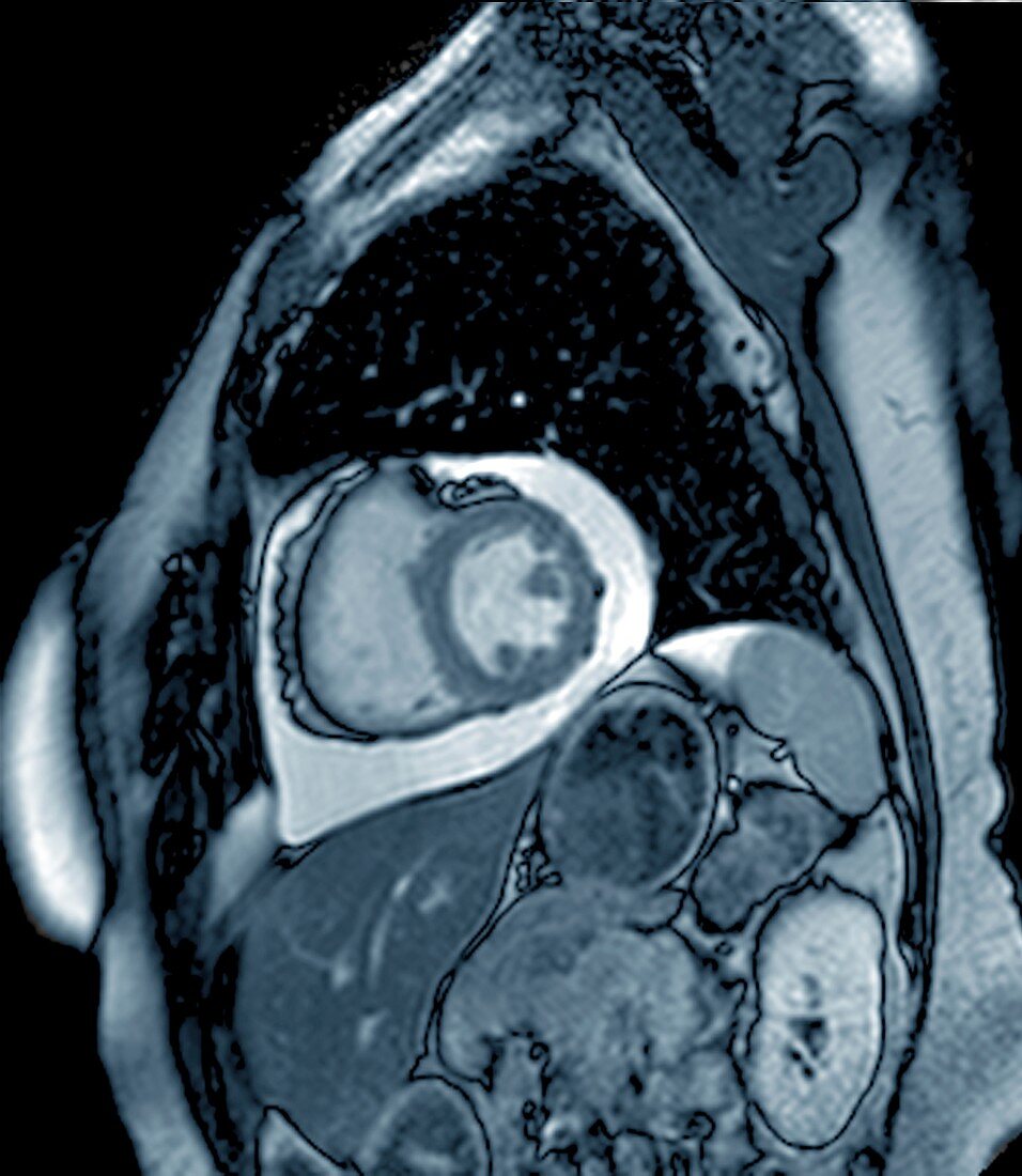 Chronic pericarditis, MRI scan