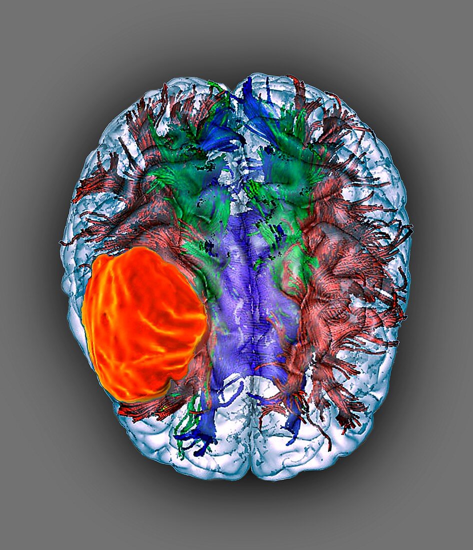 Glioblastoma brain cancer, DTI MRI scan