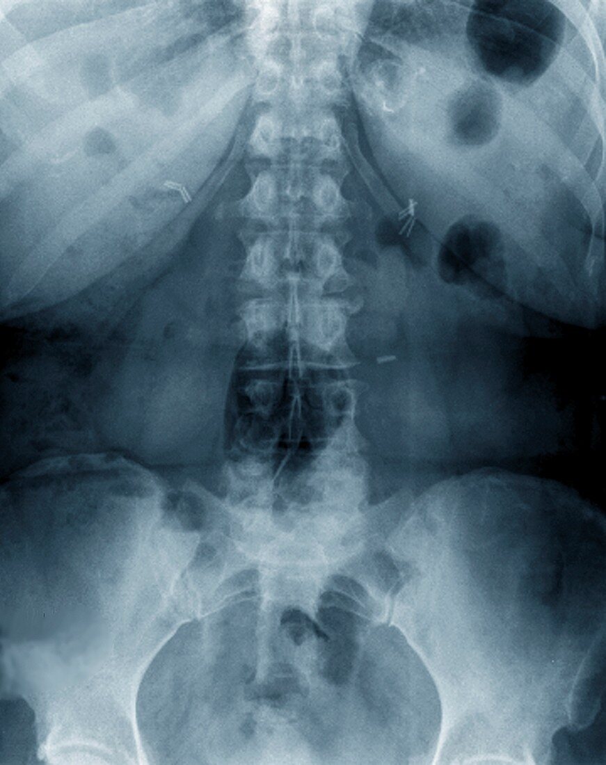 Gastric bypass, X-ray