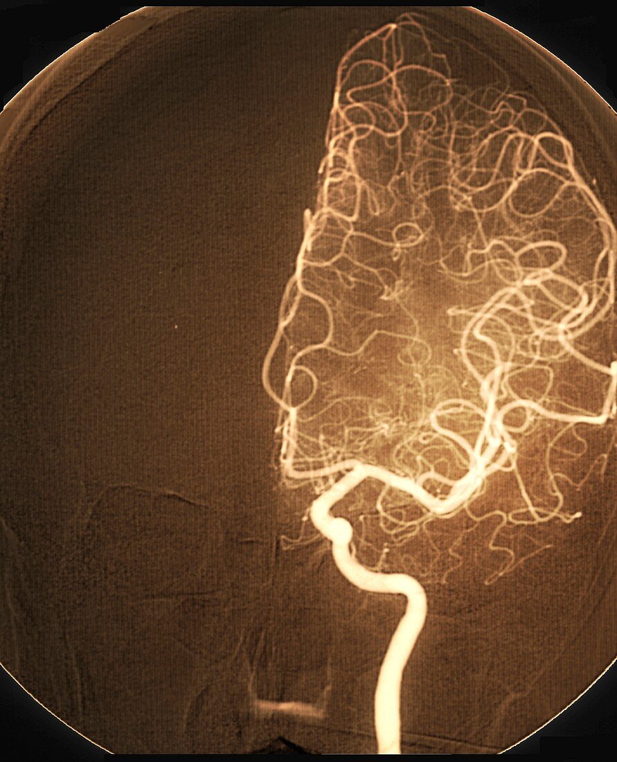 Brain arteries after stroke treatment, angiogram