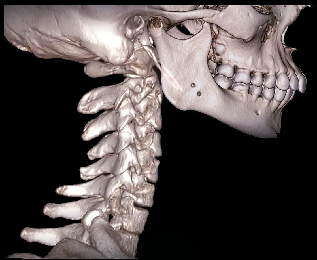 Human cervical spine and skull, 3D CT scan