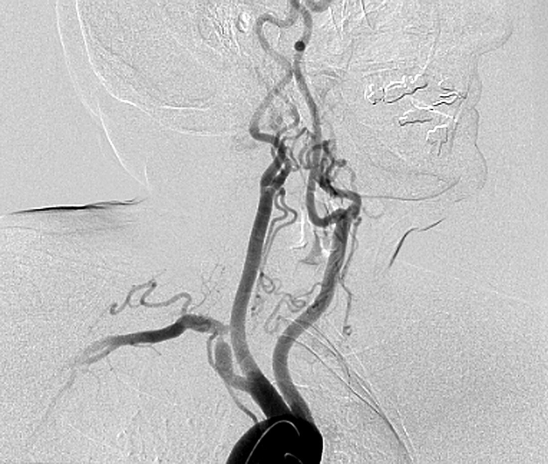 Reduced blood flow in polyvascular disease, angiogram