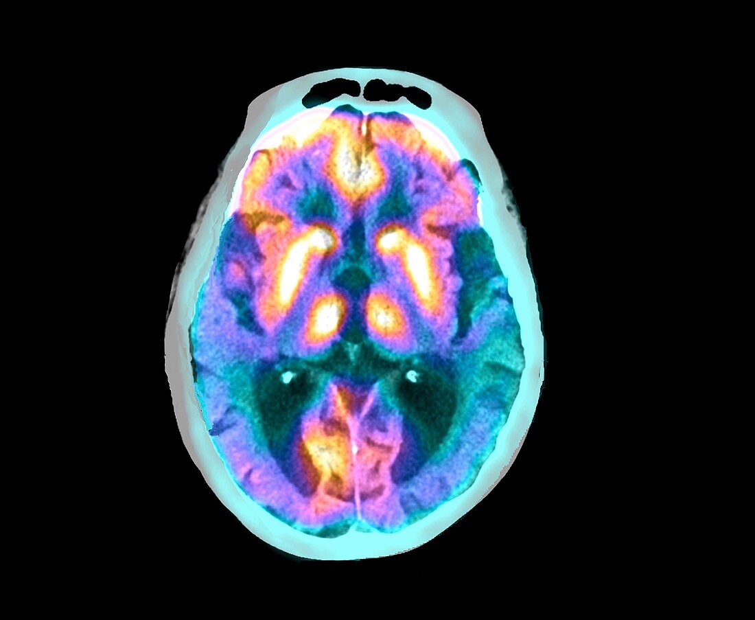 Alzheimer's disease, PET-CT brain scan