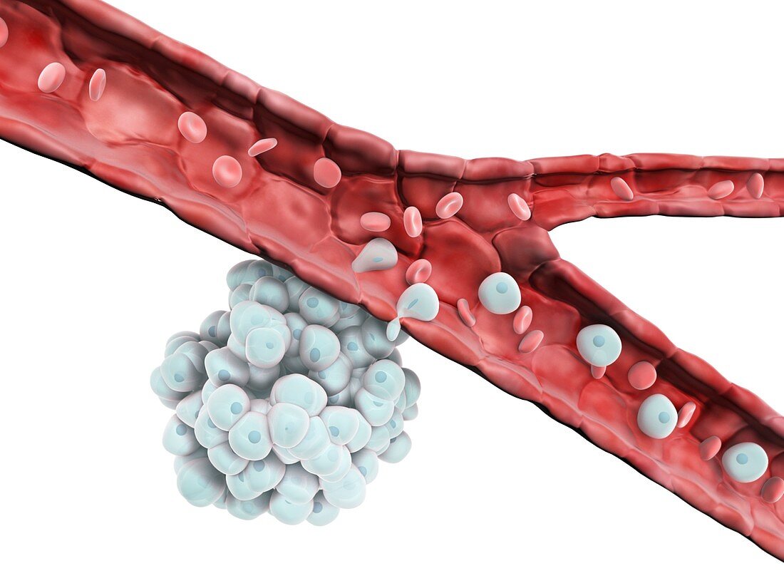Cancer cells spreading, illustration