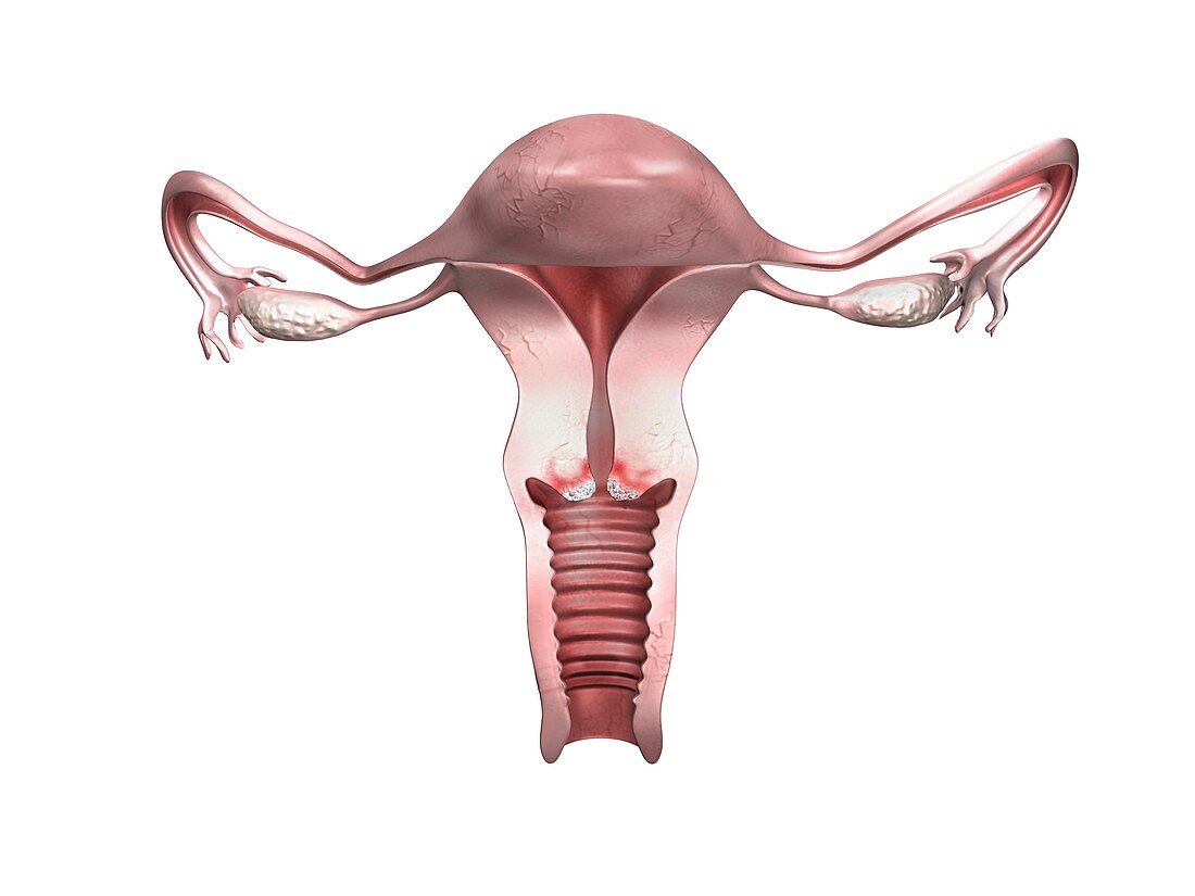 Cervical cancer, early stage, illustration