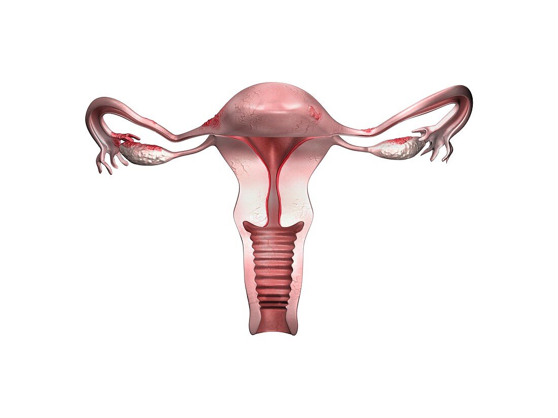 Mild endometriosis, illustration