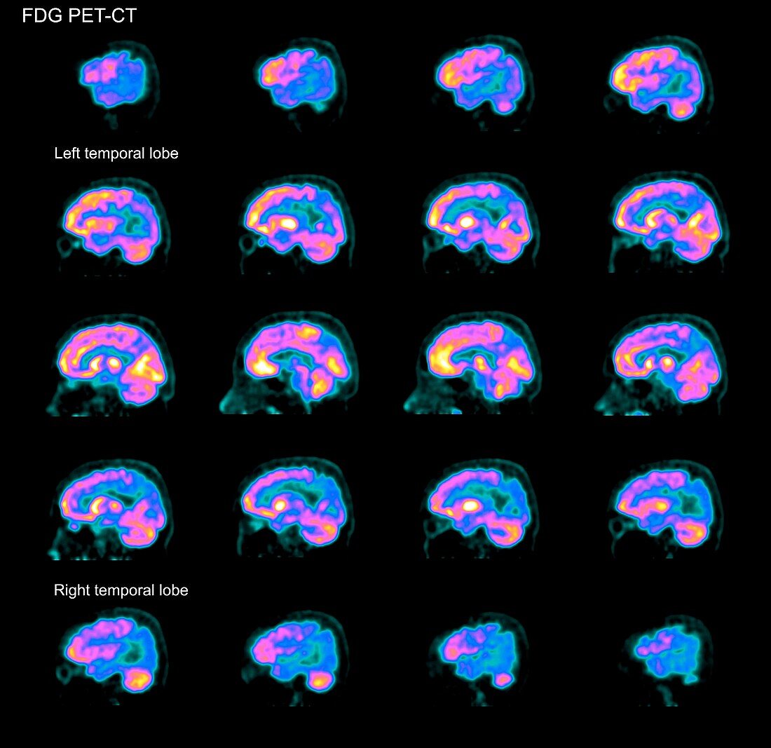 Alzheimer's disease, PET brain scans
