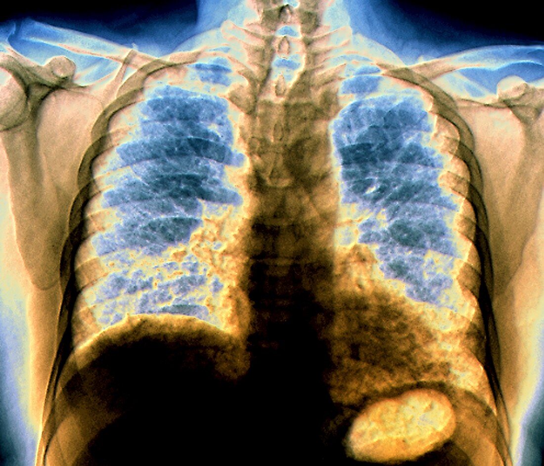 Pulmonary fibrosis, chest X-ray