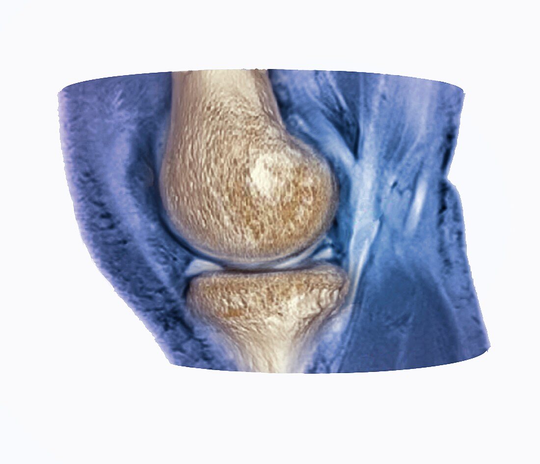 Knee meniscus injury, 3D CT-MRI scan