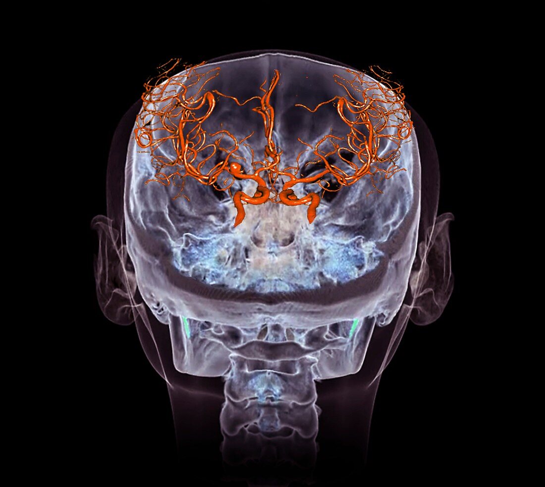 Cerebral aneurysm, 3D CT angiogram
