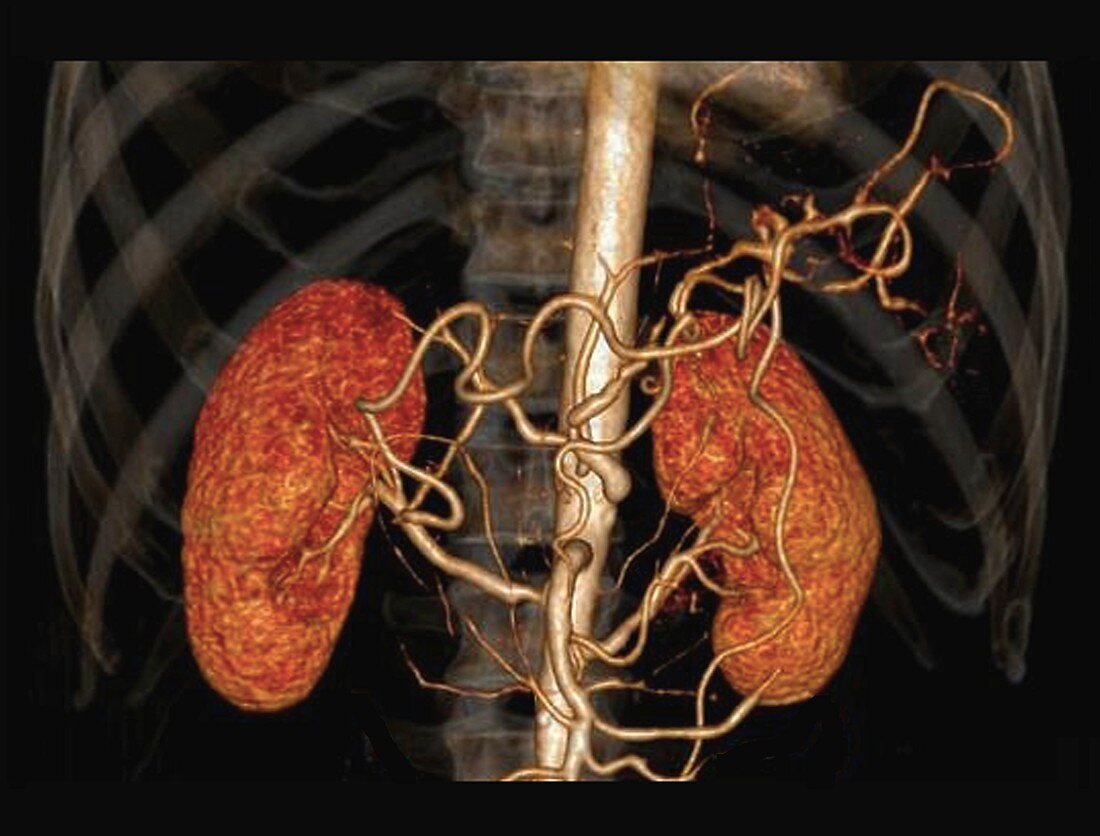 Hypertension and stenosis of renal artery, 3D CT angiogram