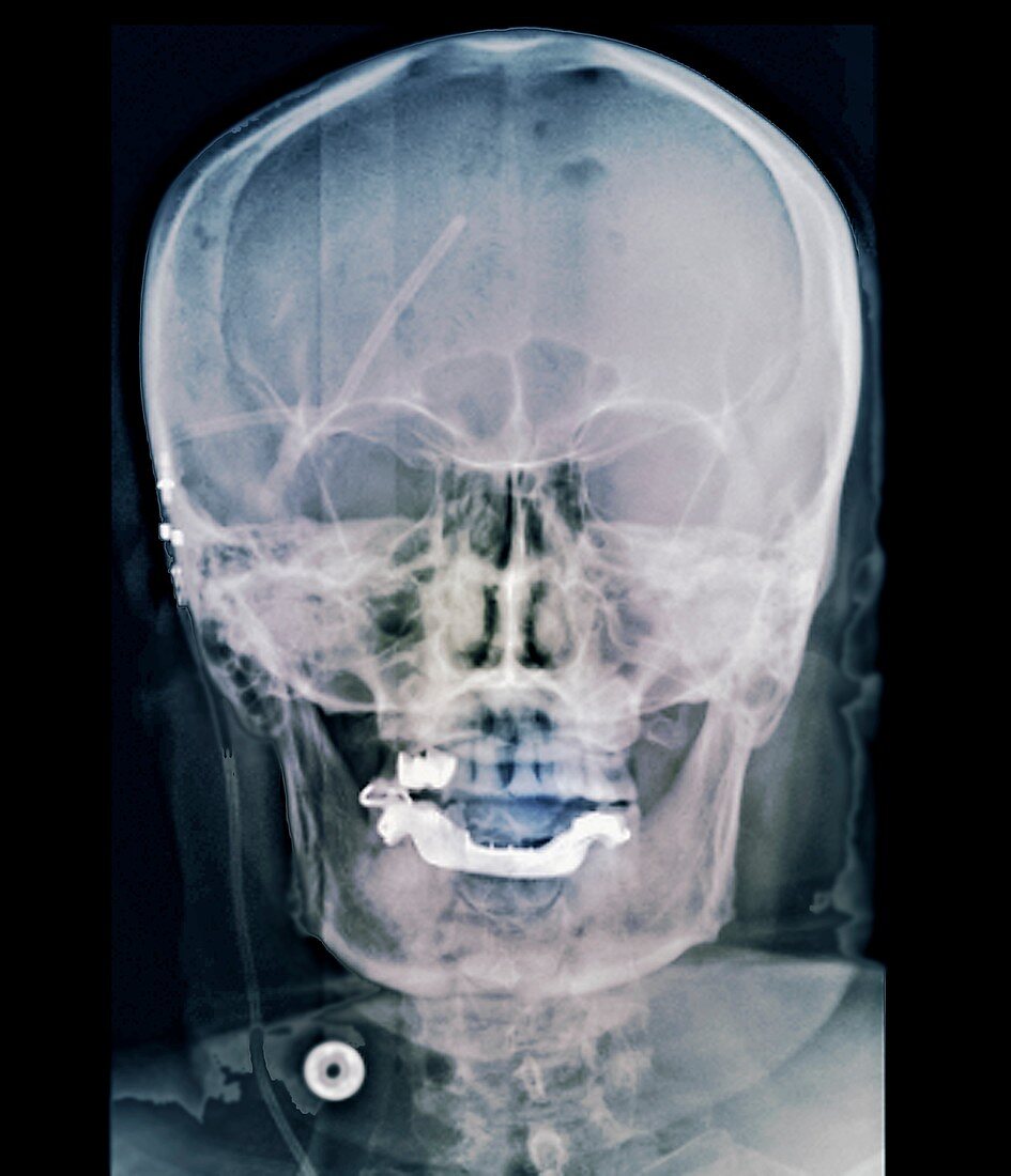 External ventricular drain in neurosurgery, X-ray