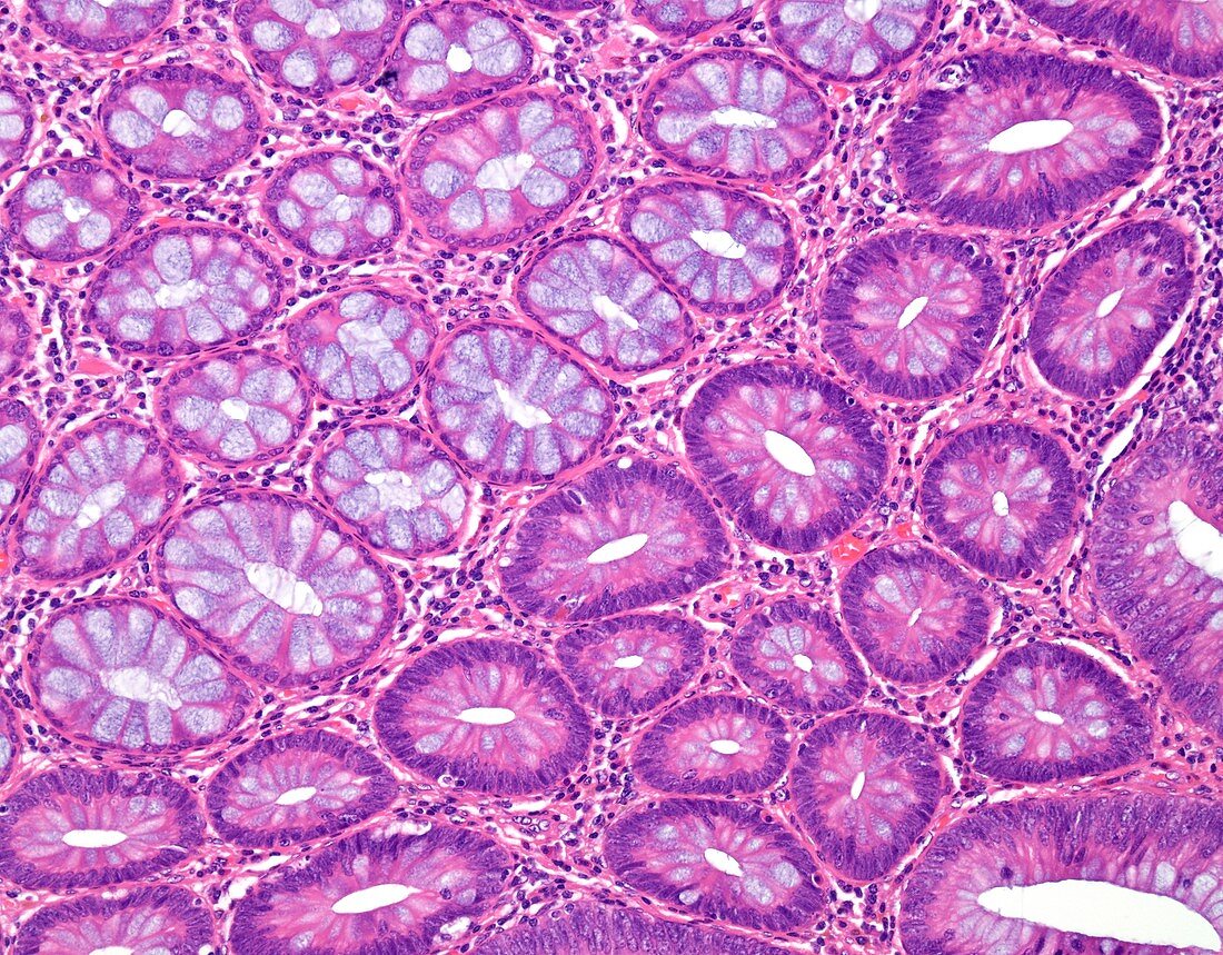 Tubular colon polyp, light micrograph