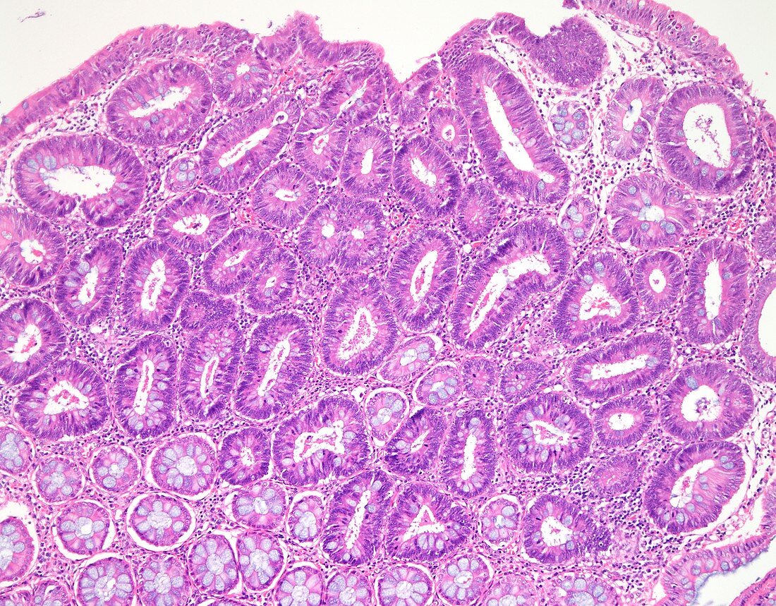 Tubular colon polyp, light micrograph