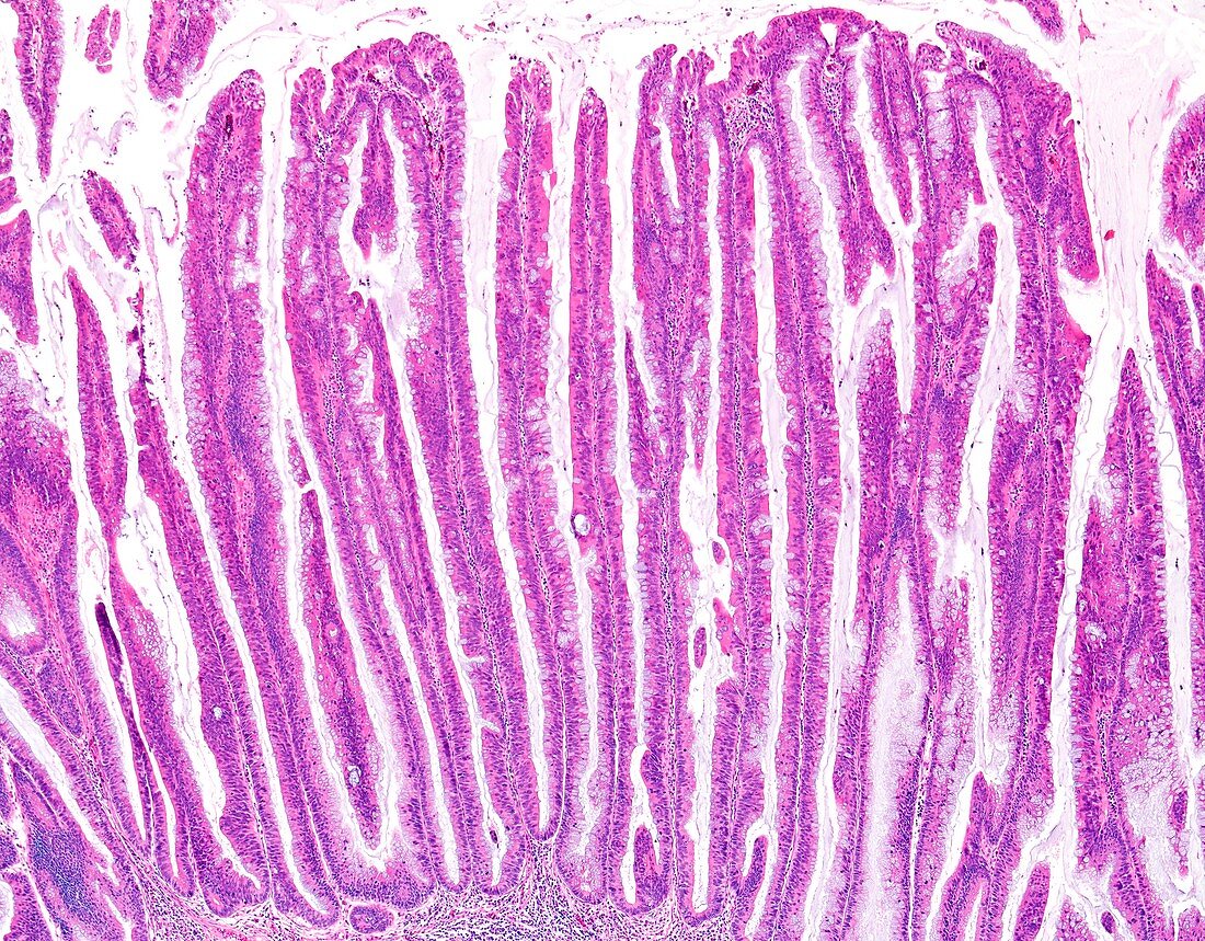Villous colon polyp, light micrograph