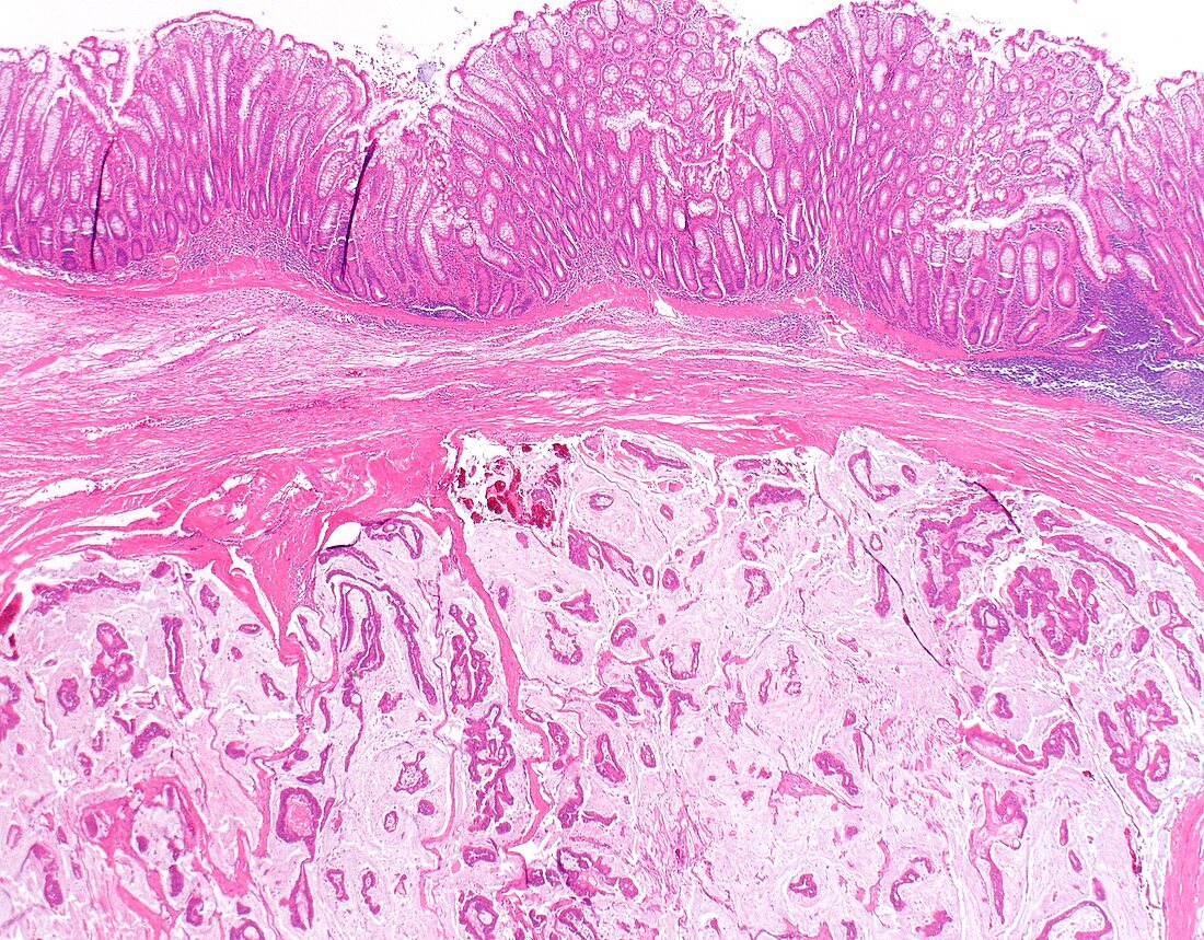 Mucinous carcinoma of the colon, light micrograph