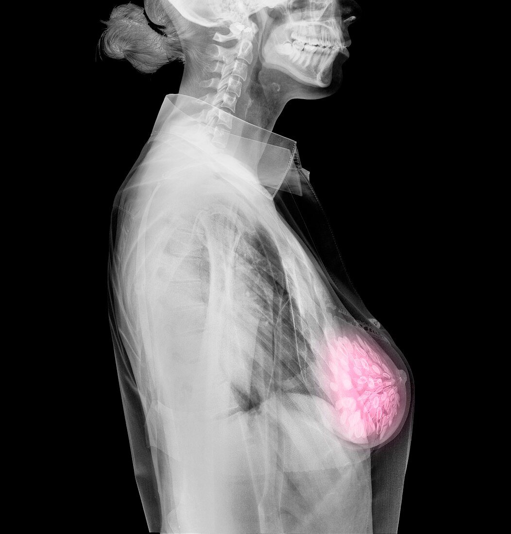 Breast cancer awareness, conceptual image