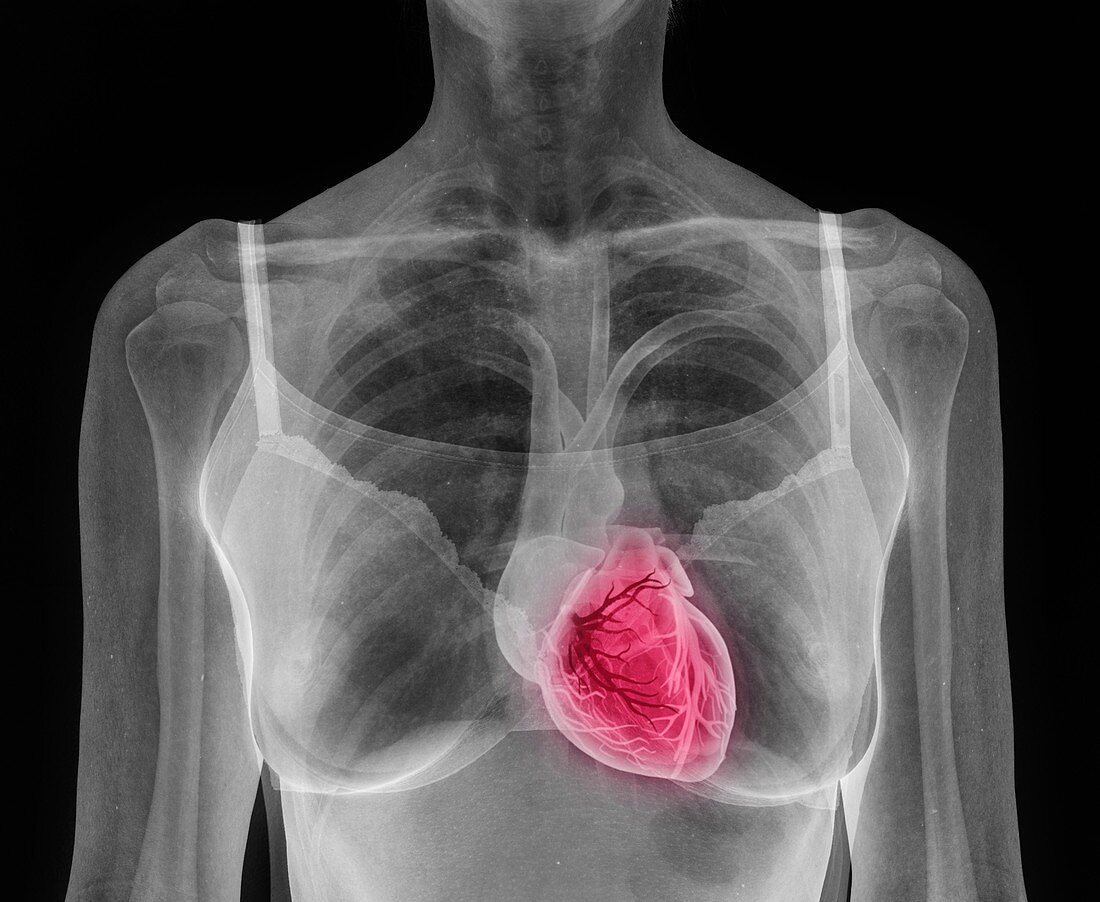 Woman's heart, composite X-ray