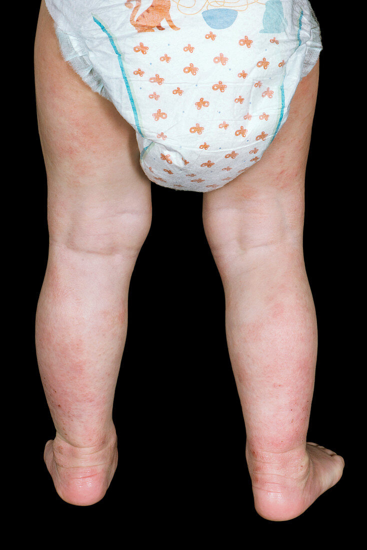Atopic eczema on a baby's legs