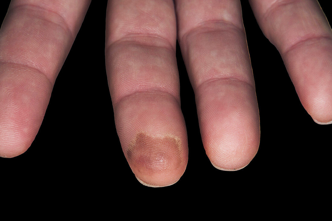 Cold burn on a finger tip