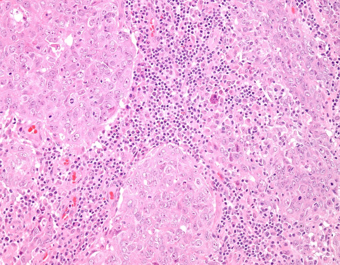 High grade invasive ductal breast cancer, light micrograph